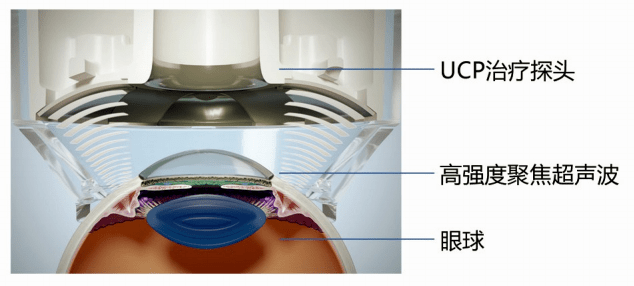 关于青光眼的方方面面都在这里还有你关心的ucp