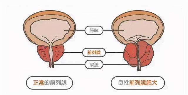 前列腺增生的"苦",很多人都受过,3类常用药物,本文