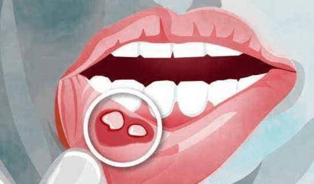 或有这7个"现象",希望你别熟视无睹_黏膜_恶性肿瘤_白斑
