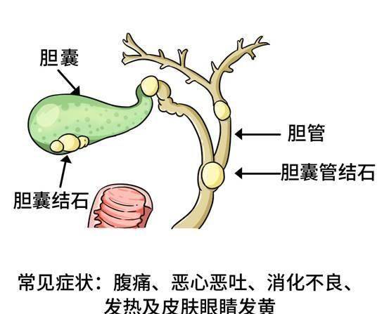 一般是下面两种:胆固醇结石,胆红素结石导致胆结石的原因胆结石如何治