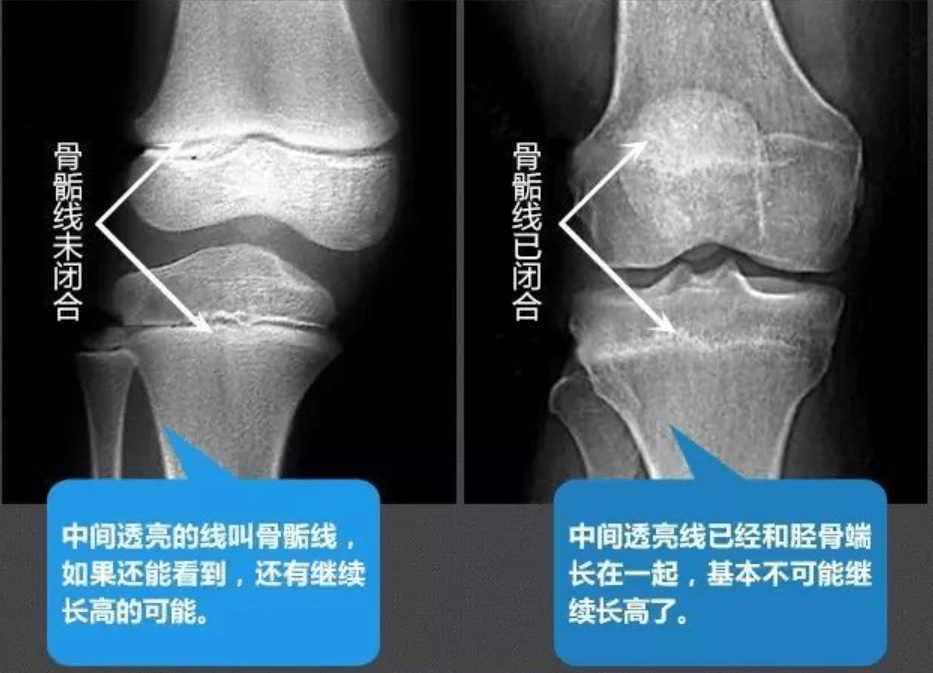 爸爸1米75妈妈1米65,女孩14岁身高只有1米55,医生：身高定型了