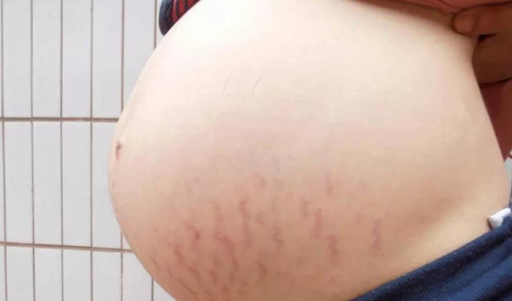 ＂毁容式＂怀孕之妊娠纹：10个孕妈9个长纹,教你咋应对咋预防