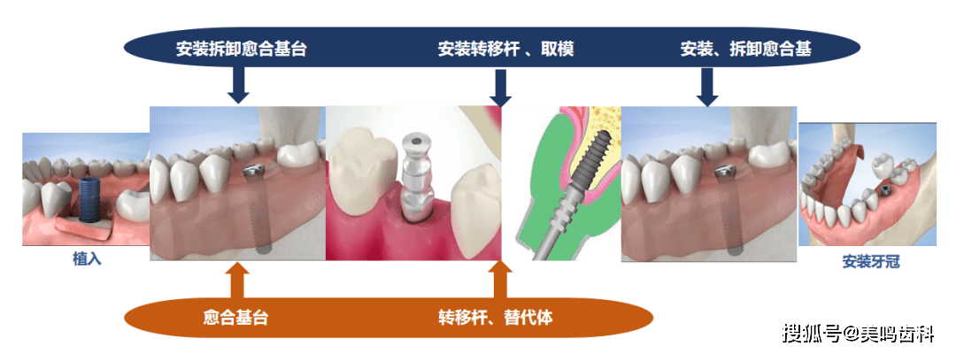 美鸣三代"四合一"新型愈合基台,种植修复的更优选择!_口腔_牙龈_扫描