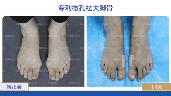 北京苏敬达医生:如何避免大脚骨手术复发,选对方式很关键!