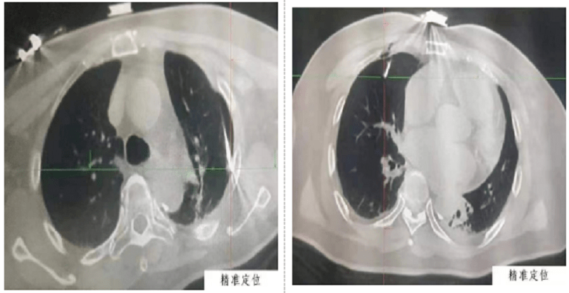 西安医学院第一从属病院开展电磁导航引导精准定位经皮穿刺肺结节射频消融术