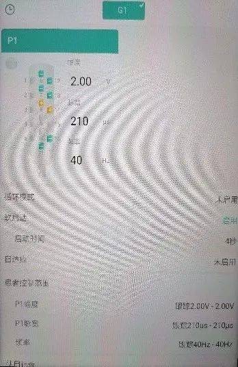 重庆首例运动皮层刺激疗法治疗丘脑卒中后痛苦悲伤案例