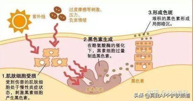 青春痘印能自我淡化？网友：别做梦了，不防晒就等着满脸黑点吧