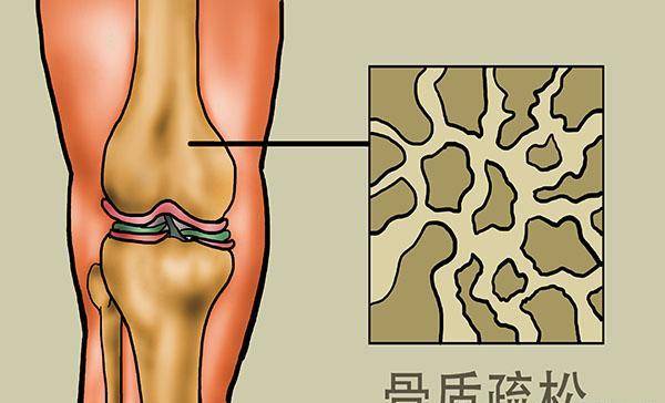 为什么人年纪大了就容易骨折？弥补哪些营养，有助养骨？