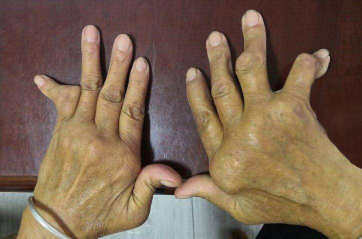 类风湿性关节炎如何治愈？这五种方法一定要了解！