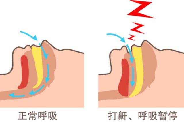 打鼾的学名是“睡眠呼吸暂停综合征”，简单来说就是睡眠的时候产生呼吸
