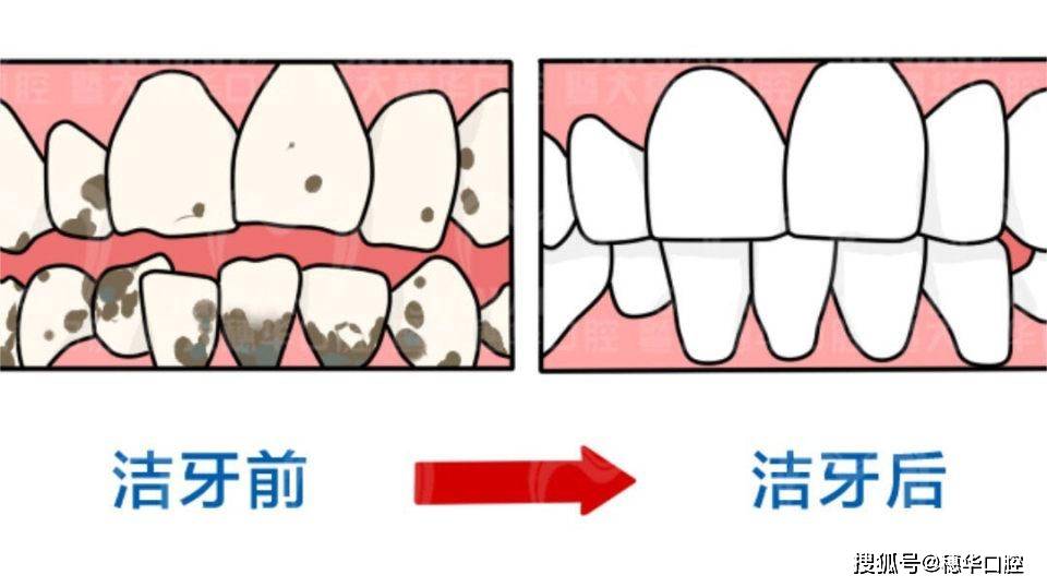 常喝咖啡招致牙齿变黄？4招教你若何预防！