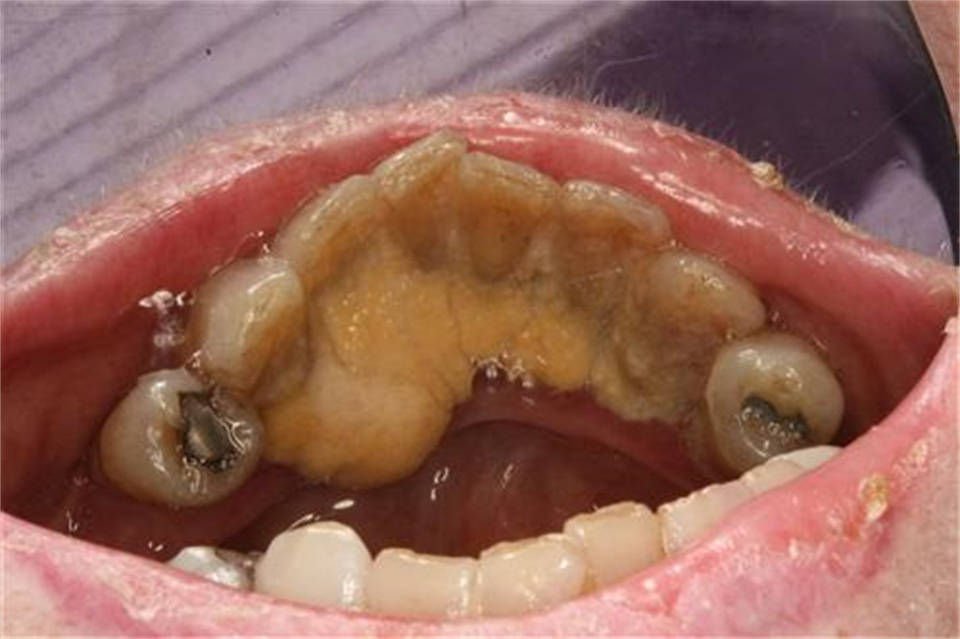 牙上的“牙石”别再手抠了！刷牙时这样做，一整片的牙结石也能掉！