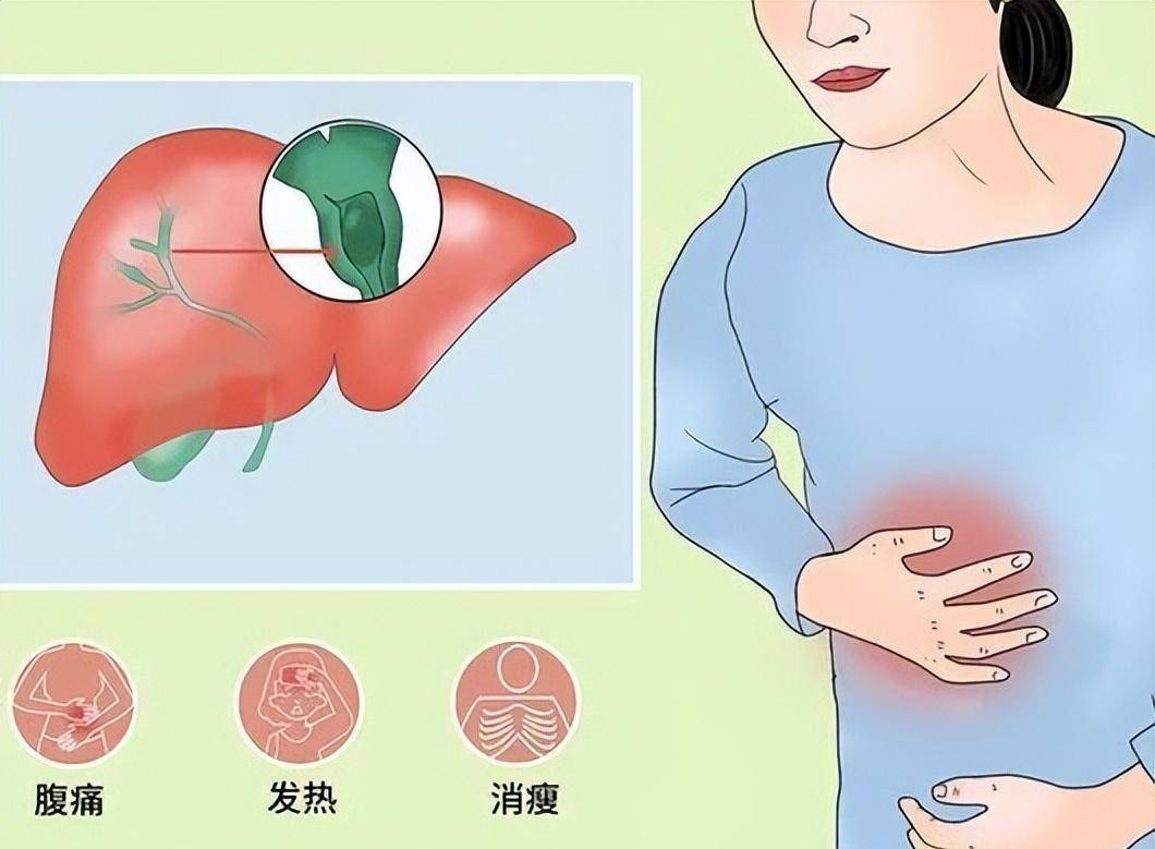 治疗急性胆囊炎首选替代治疗方法，经皮胆囊造瘘术疗效怎么样？