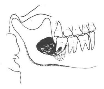 这里有一例5000年前古人类的颌骨骨髓炎考古也需要口腔医学知识