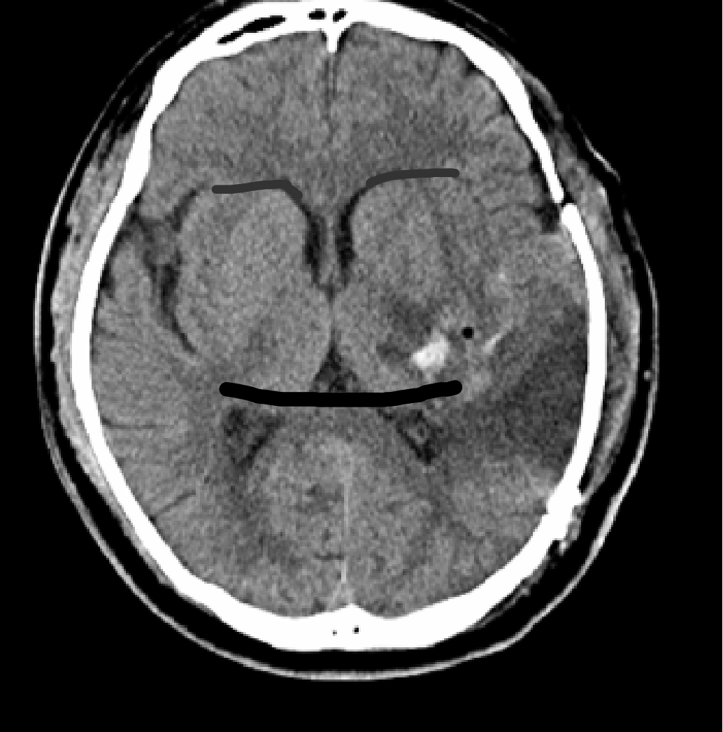死地只有一招可以破解!脑组织被挤变形?这种快速置人于死地的危重状态