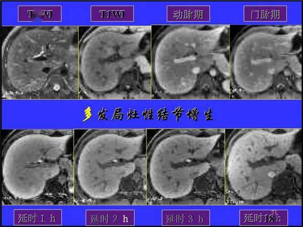 肝内局灶病变是什么意思 222f8e472d2f4ae4bccdae2ff9e34c59.jpeg