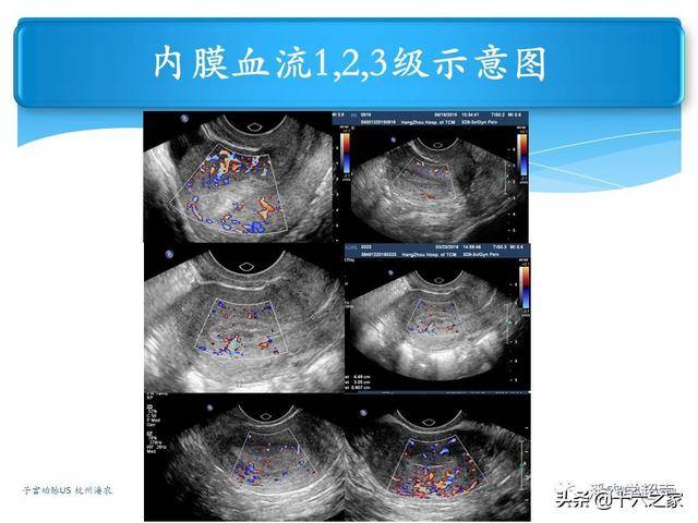 子宫动脉超声检查