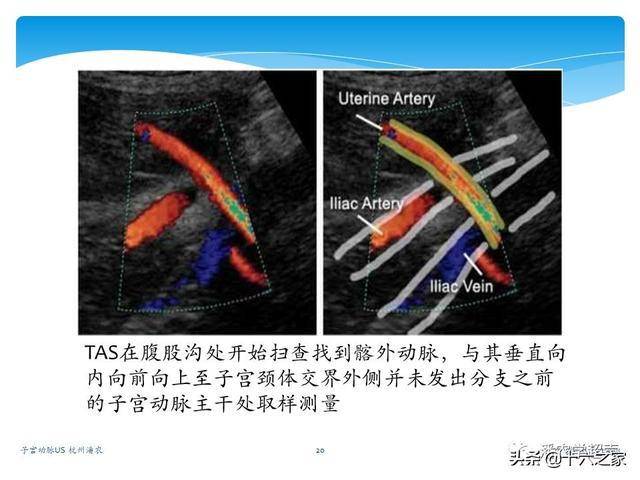 子宫动脉超声检查