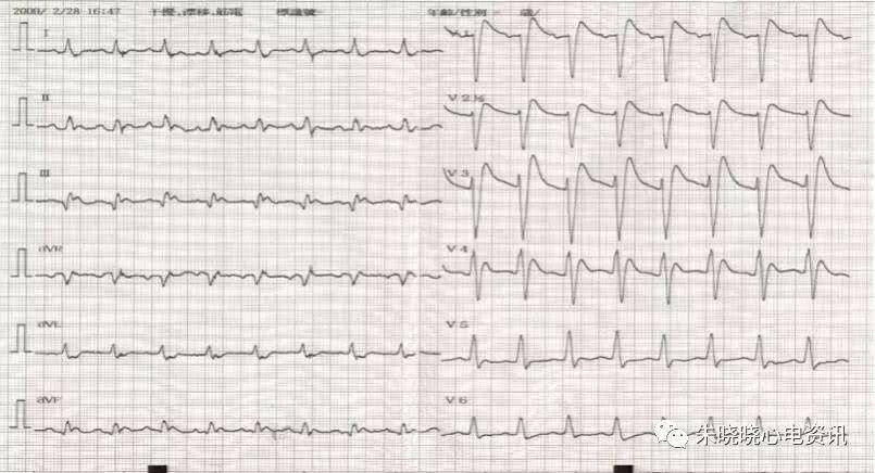 1.ami心电图特征新见:j波