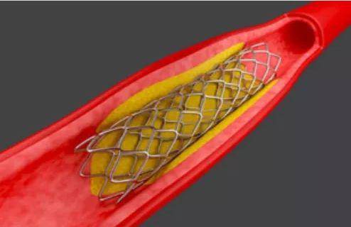 健康科普丨心脏支架后要吃抗排异药吗?心梗后该吃哪些药?