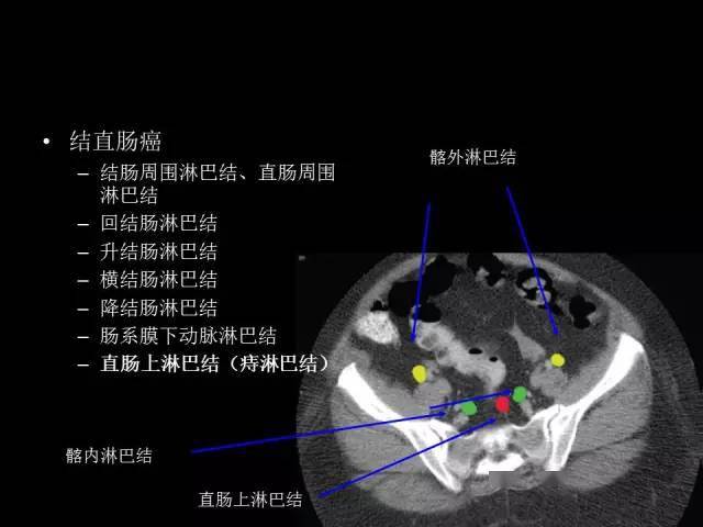 【收藏】全腹部高清ct图谱,淋巴结彩色图谱,血管解剖图谱大汇总!