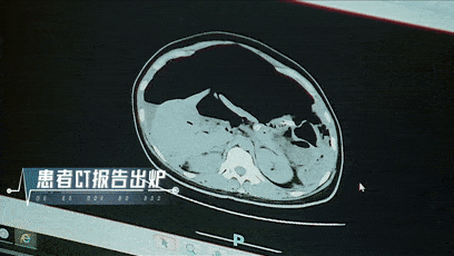 「肠子」肠子被“撑烂”进ICU“想死！别告诉我儿子！”51岁女护士患癌