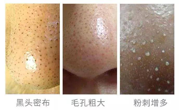 又爽又恶心的去黑头方法来了!
