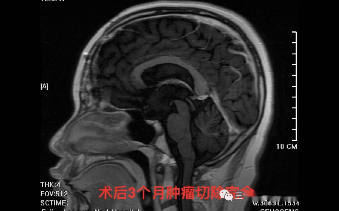 颅咽管瘤切除术后3个月复查