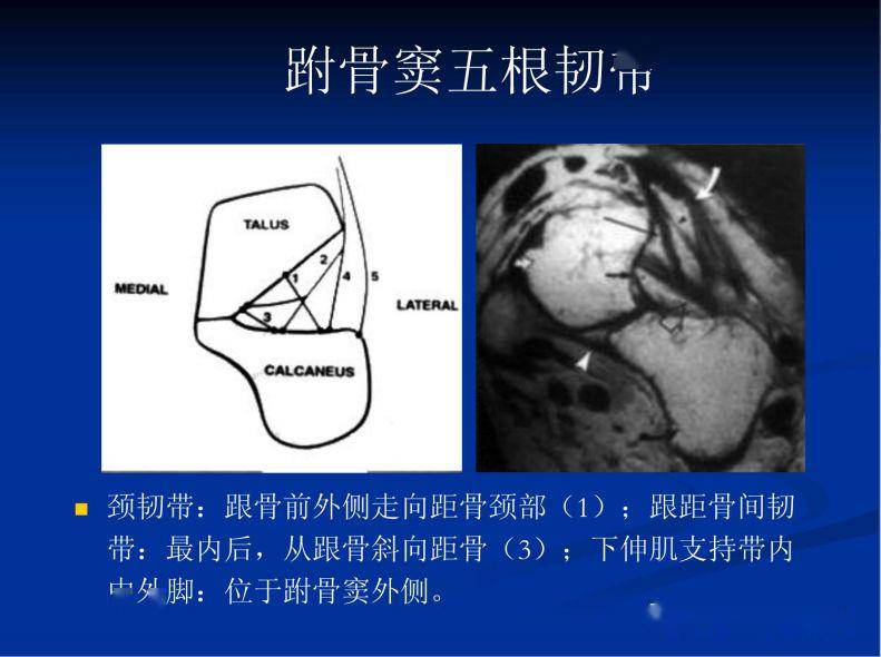 跗骨窦综合征临床与影像