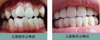 [牙齿]六·一送孩子这份礼物最有意义~~家长