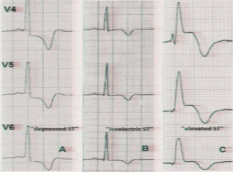 一文速览:常见心肌病的心电图表现_左室