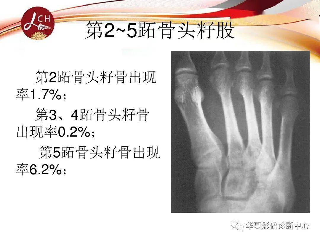 工作中有意思的足部副骨与籽骨