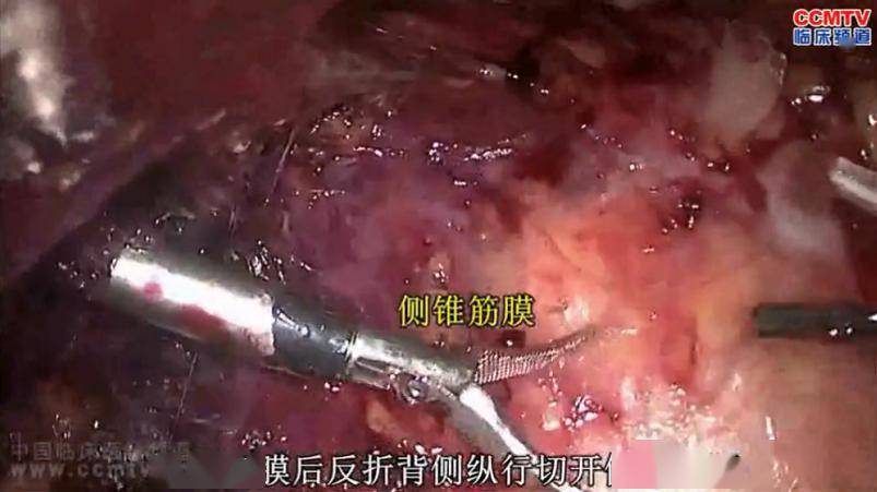 手术演示丨解剖性后腹腔镜根治性右肾切除术
