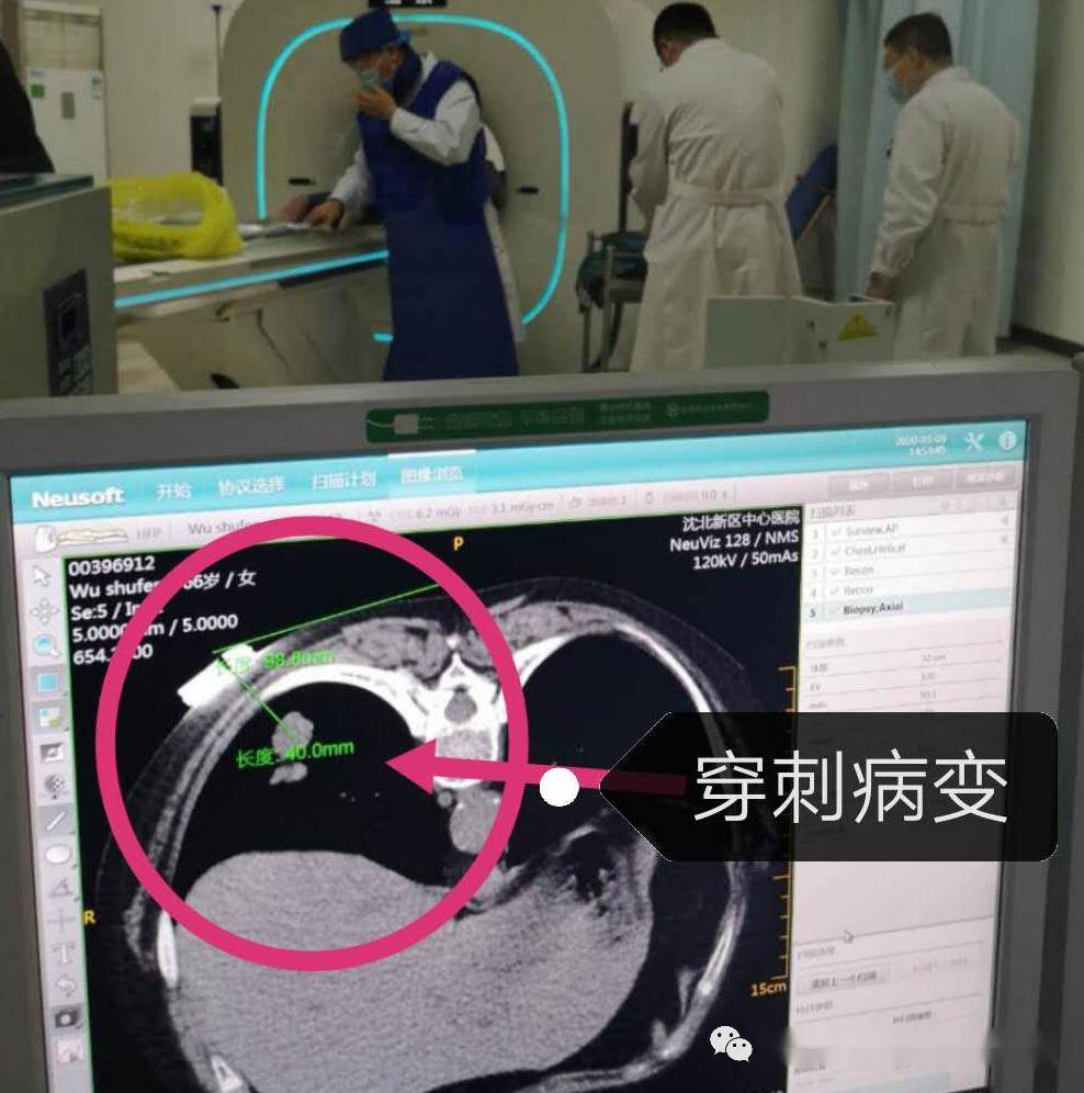 我院胸外科成功实施两例肺占位ct引导肺穿刺活检术及胸腔镜下肺癌根治