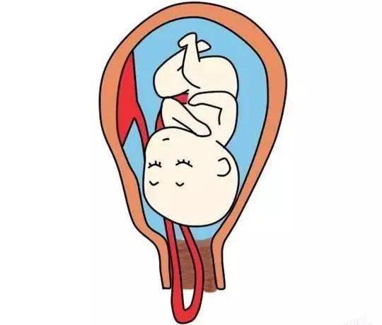 脐带脱垂是一种严重危及围产儿生命安全的产科急症之一.