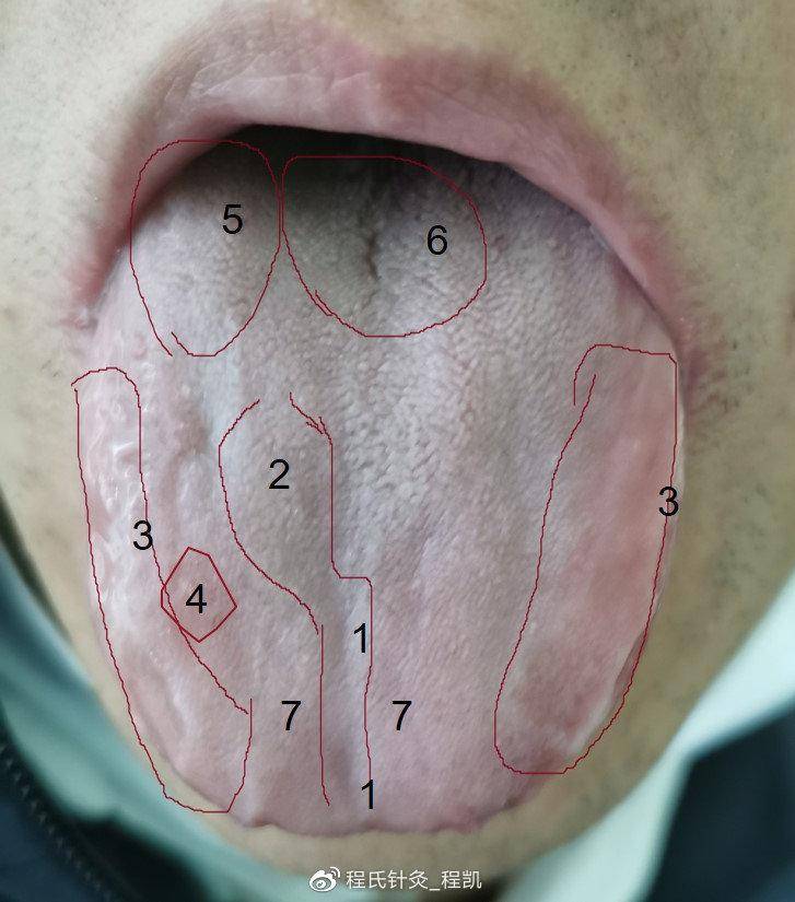 从一张舌头照片上,可以看出多少健康问题?
