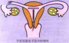 子宫环有圆形,宫腔形,t字形等多种形态,医生会根据每个人子宫的情况