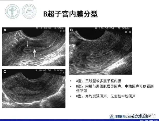 b超检查子宫内膜回声不均我到底得了什么病