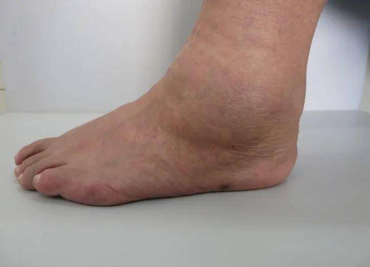 足踝部骨性关节炎(肿胀变形)