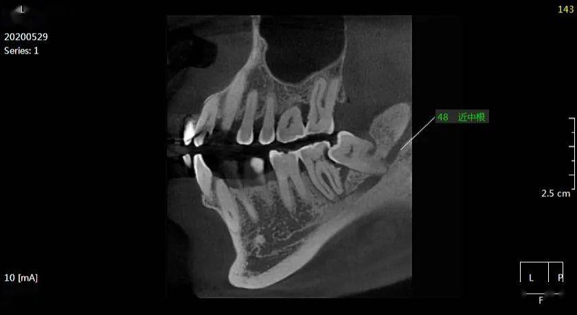 王xx 20200529 智齿cbct 135xxxx6066