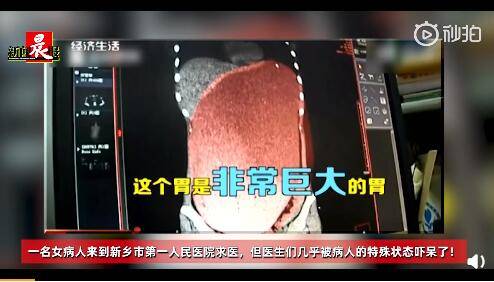 女子减肥后报复性进食送医院：10个包子+4根鸡腿