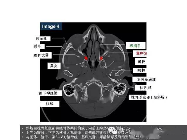 鼻咽部的详细解剖(含各个孔道)