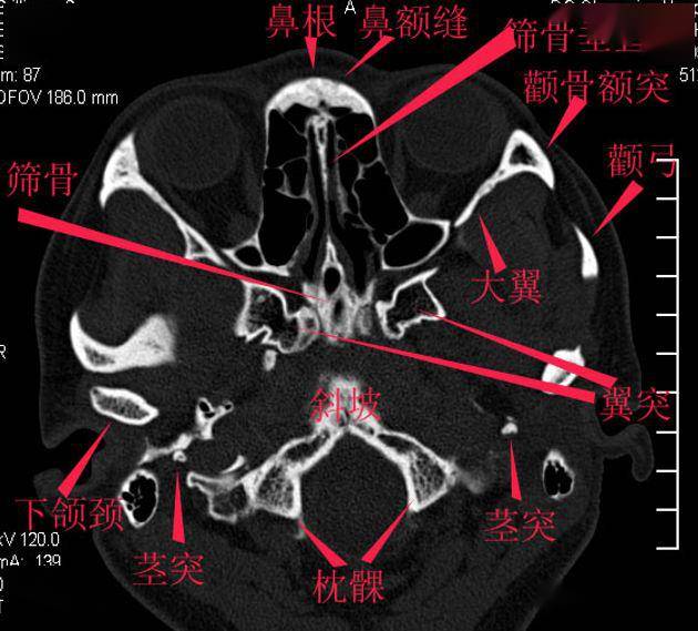 纯手工详细标注的颅底解剖太赞了