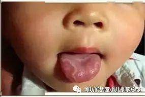小孩子正常舌苔图片 5444b009c2f24c5dbf73c36e178b3790.jpeg