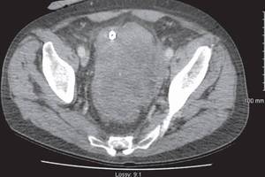 直播预告 | 孩子做ct会得甲状腺癌吗?----甲状腺癌