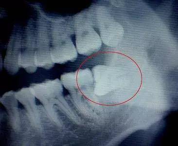 所以最好去医院拍一个x光片,看看智齿的状况,医生会通过口腔检查和x光