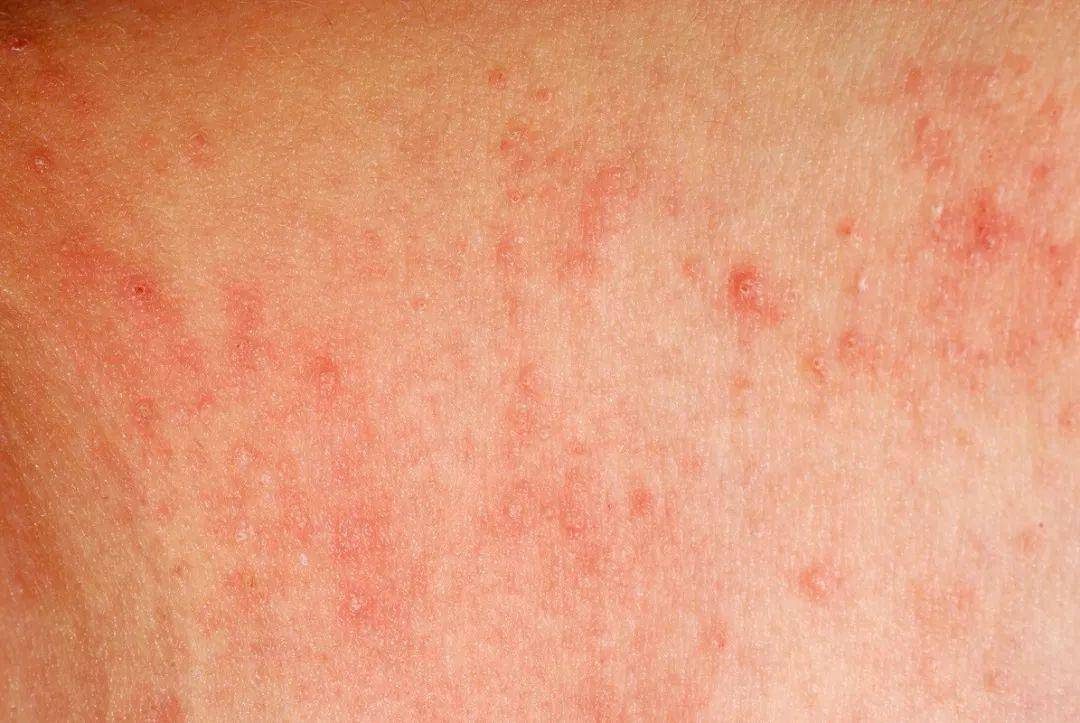 干性湿疹是什么原因引起的?广州粤波湿疹