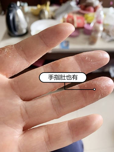 32岁女子手上起个小泡,很痒,医生:少做3事,多涂1物