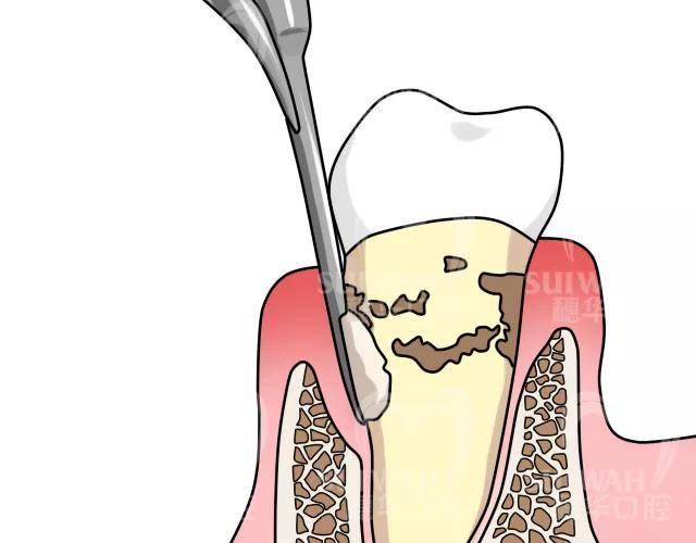 为什么牙结石会长在牙龈下面?