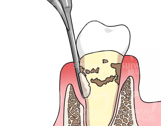为什么牙结石会长在牙龈下面